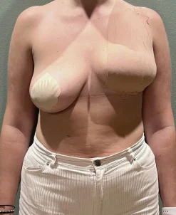 AISO Breast Tape 10cm Cholo